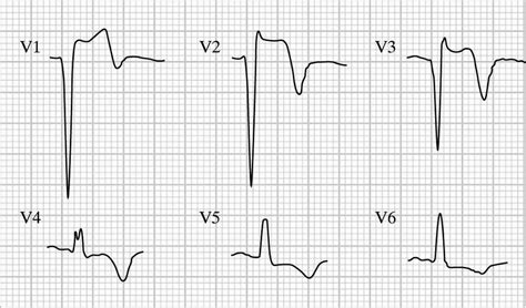 lv aneurysm ecg|what is an apical aneurysm.